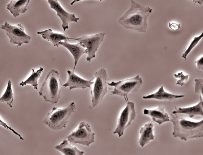 Breast Cancer Cells micrograph